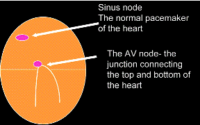 DIagram showing how a normal heartbeat works