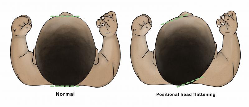 Image showing plagiocephaly/positional head flattening in a baby 