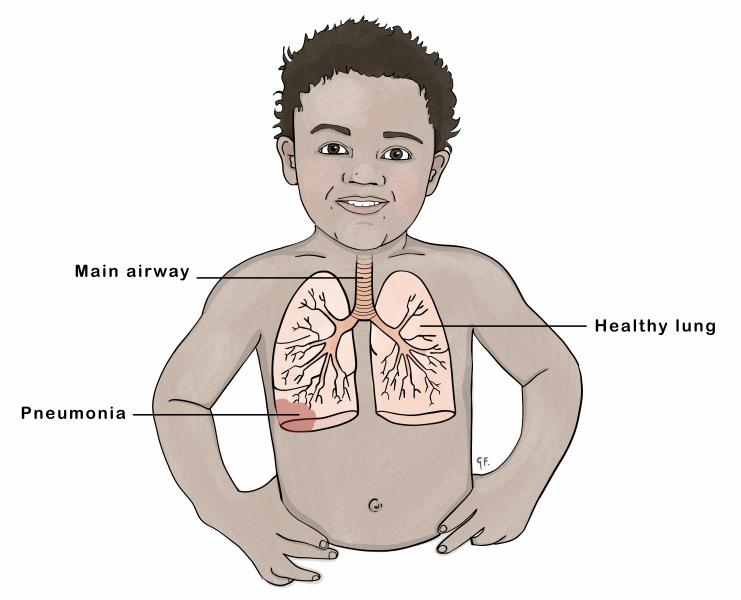 Illustration showing the effects of pneumonia on the lungs