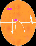 Diagramm zur Darstellung der atrio-ventrikulären Reentrant-Tachykardie