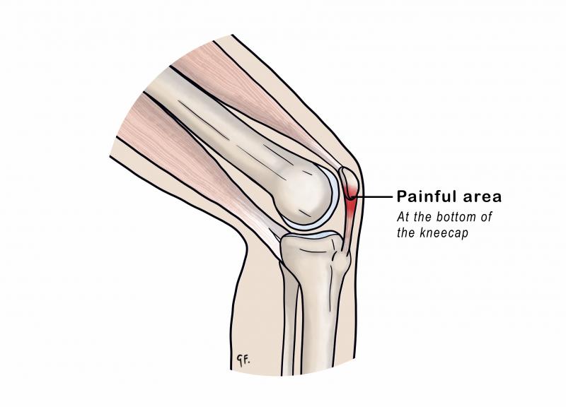 Illustration showing painful area in knee with sinding-larsen-johansson syndrome