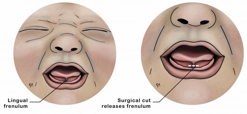 Graphic showing tongue tie in a baby on the left. On the right, the graphic shows where the snip is made to the frenulum in a tongue-tie release