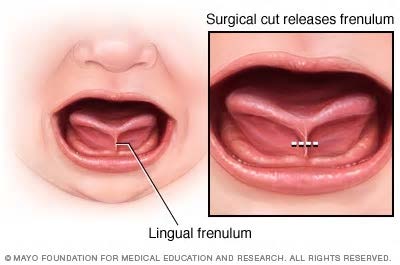 Graphic showing tongue tie in a baby on the left. On the right, the graphic shows where the snip is made to the frenulum in a tongue-tie release