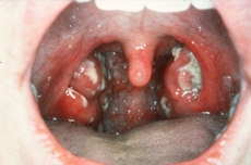 Photo showing Tonsillitis