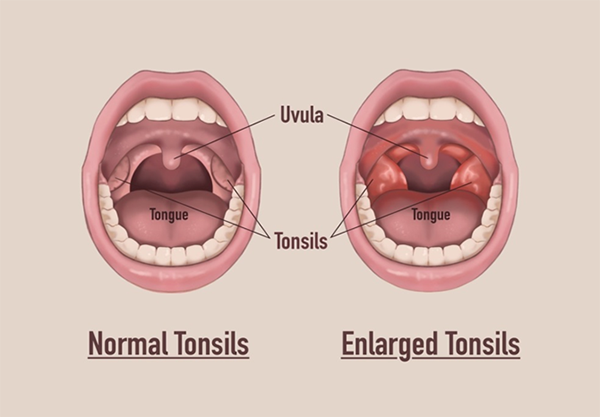 Tonsillectomy Adenotonsillectomy KidsHealth NZ