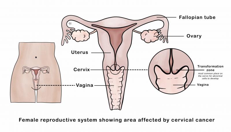 Diagram of the cervix showing where abnormal cells develop
