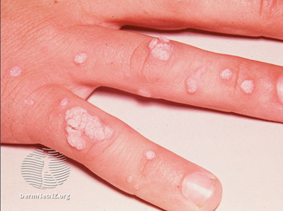 do finger warts itch