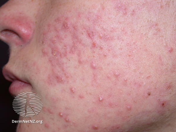 A teenager with acne on their face