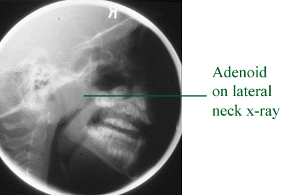 X ray showing adenoid