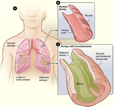 Diagram 1: Figure A shows a cross-section of the lungs with normal airways and with widened airways. Figure B shows a cross-section of a normal airway. Figure C shows a cross-section of an airway with bronchiectasis.