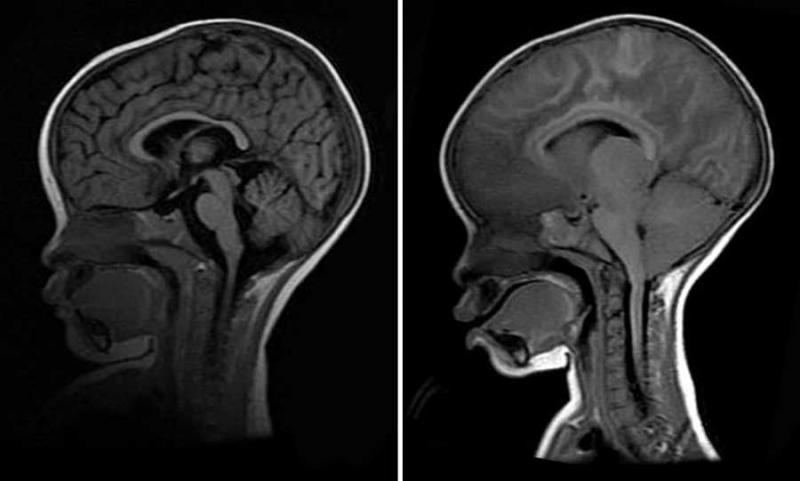 MRI images of a child's brain