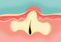 A diagram of a deep cyst