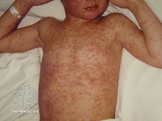 Photo of a body's chest with the measles rash