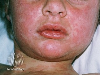 Measles | Kidshealth