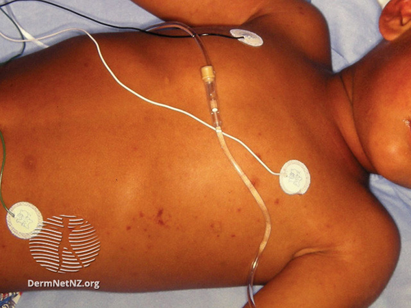 Photo of a child in hospital with meningococcal rash