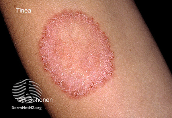 ringworm on human skin legs