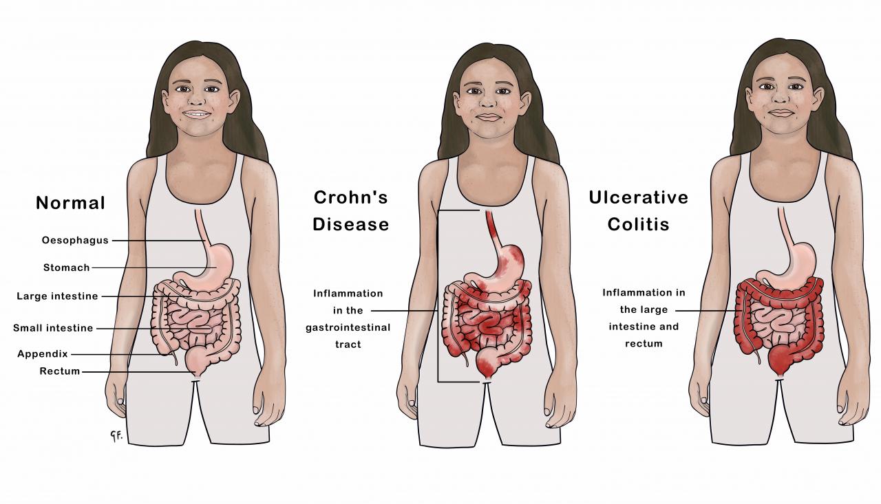 Image showing child with normal gastrointestinal tract compared with ulcerative colitis and Crohn's disease