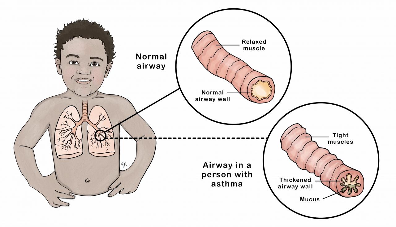Graphic of lungs and airways showing normal airways and airways in someone with asthma