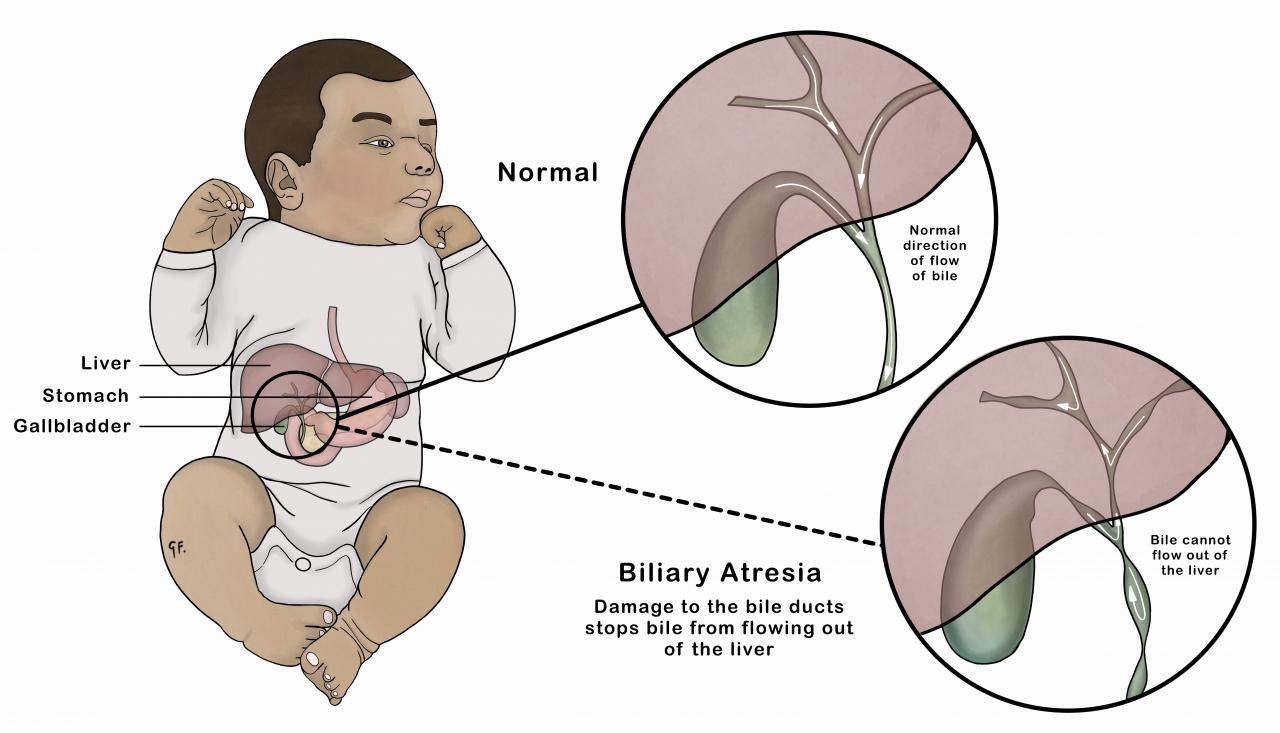 Illustration showing biliary atresia compared with a normal biliary system in a baby