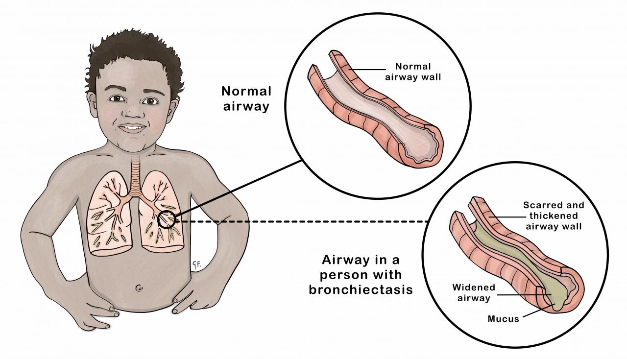 Image showing a child with cross-section of the lungs with normal airways and with widened airways