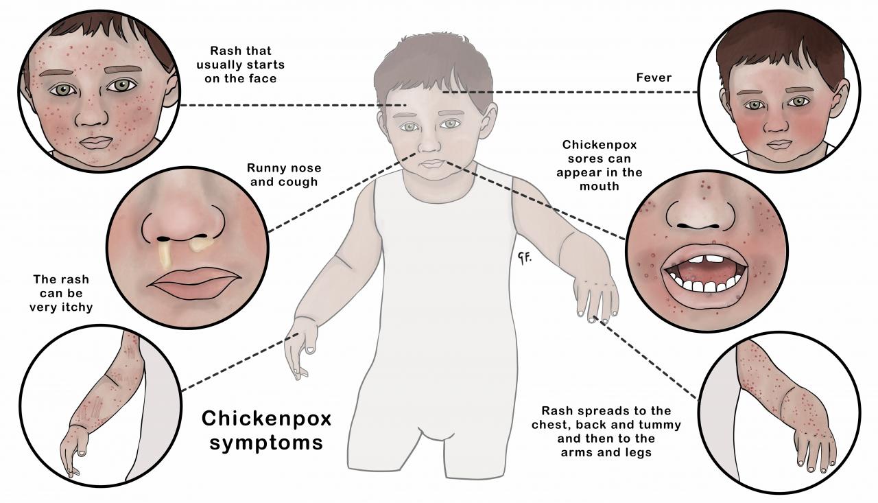 Illustration showing chickenpox symptoms
