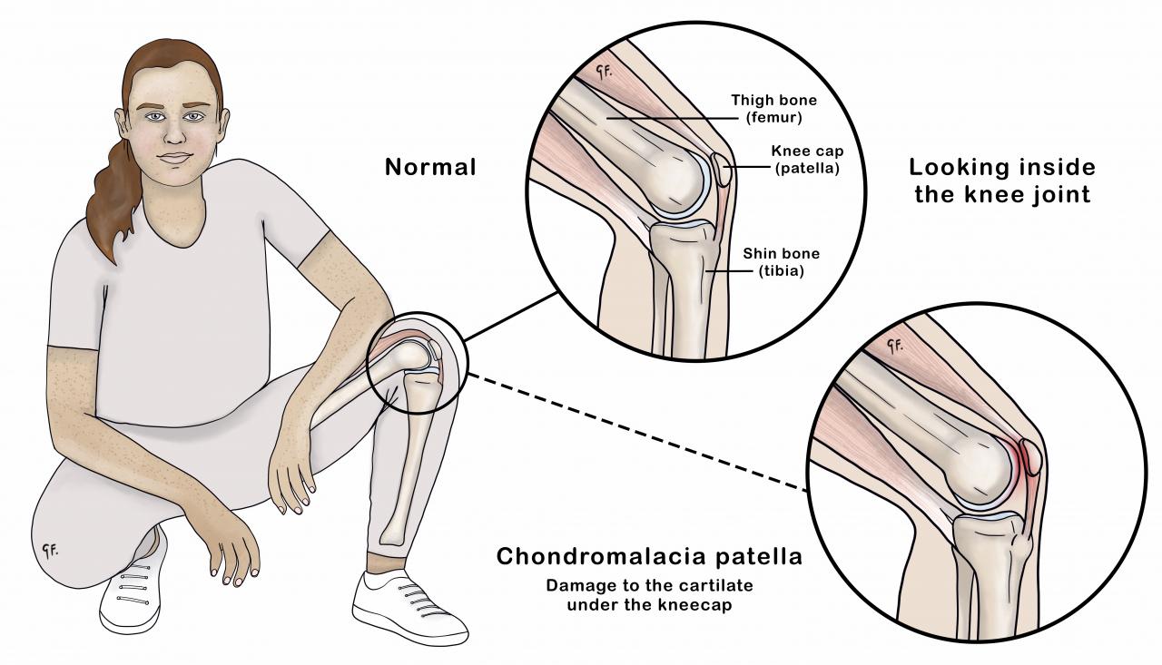 Illustration of a teenage girl showing knee anatomy and chondromalacia patella