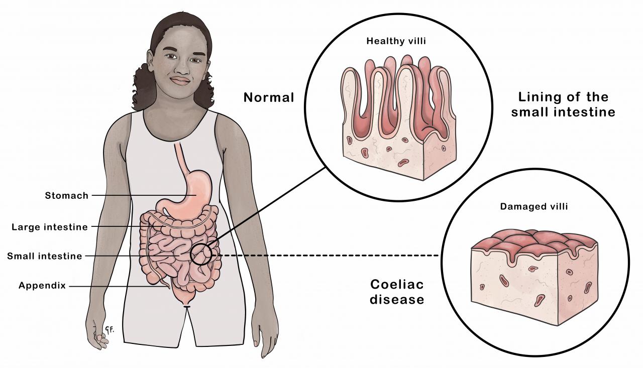 Image of a child showing small intestine changes in coeliac disease