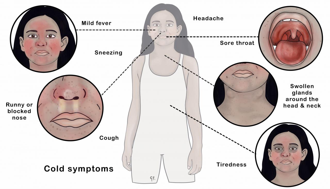 Illustration showing the symptoms of common cold in a child
