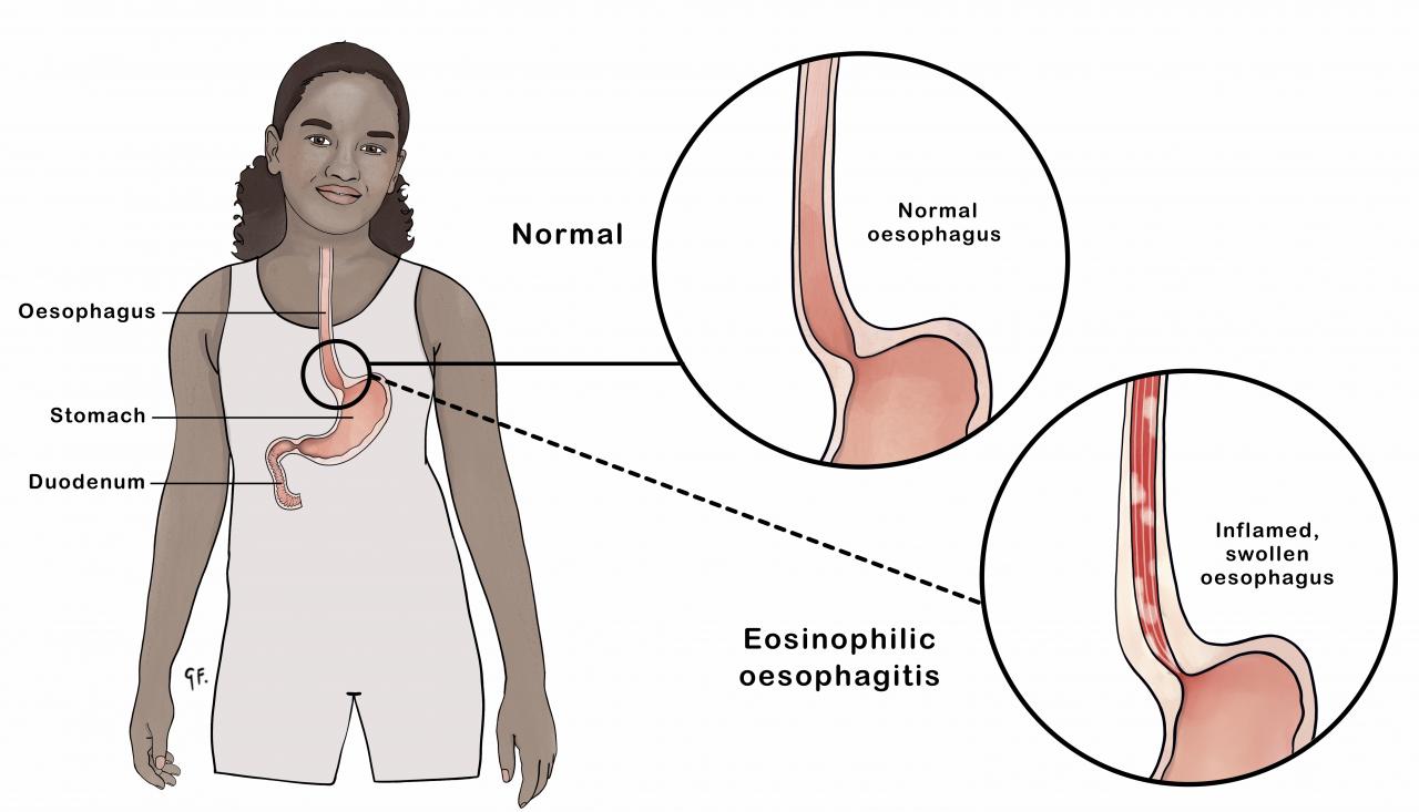 Illustration of a normal oesophagus and eosinophilic oesophagitis