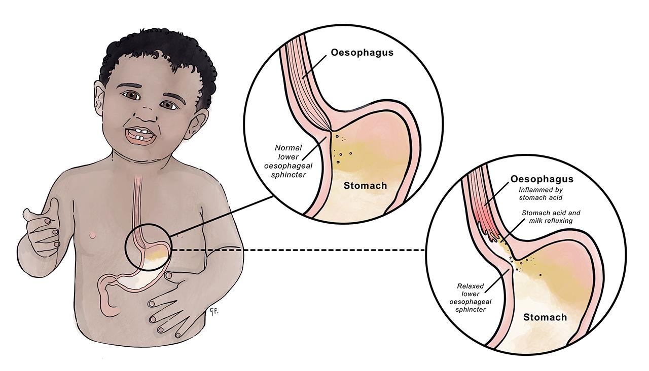Diagram of baby showing stomach and gastro reflux