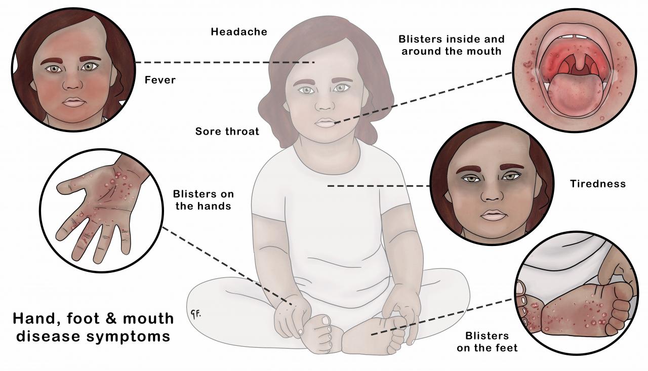 Illustration showing young child with hand, foot and mouth disease symptoms