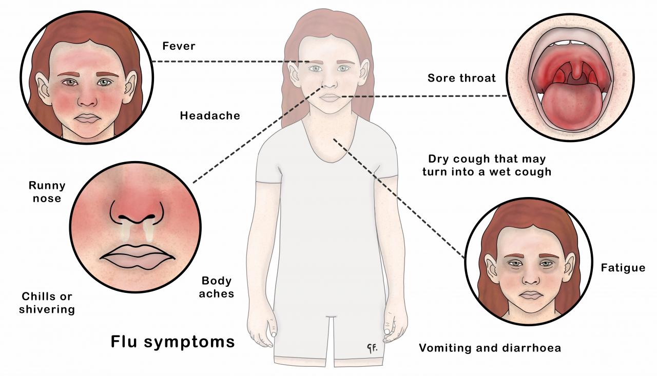 Illustration showing symptoms of influenza