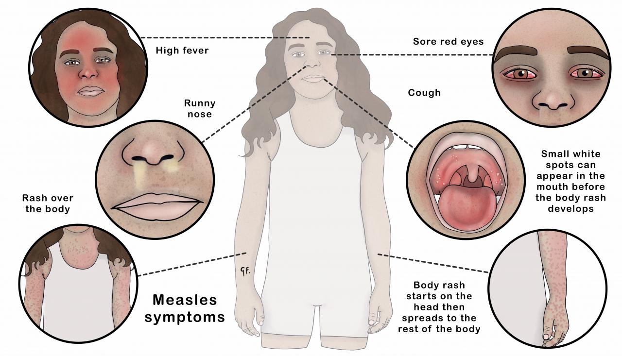 Illustration showing the symptoms of measles in children