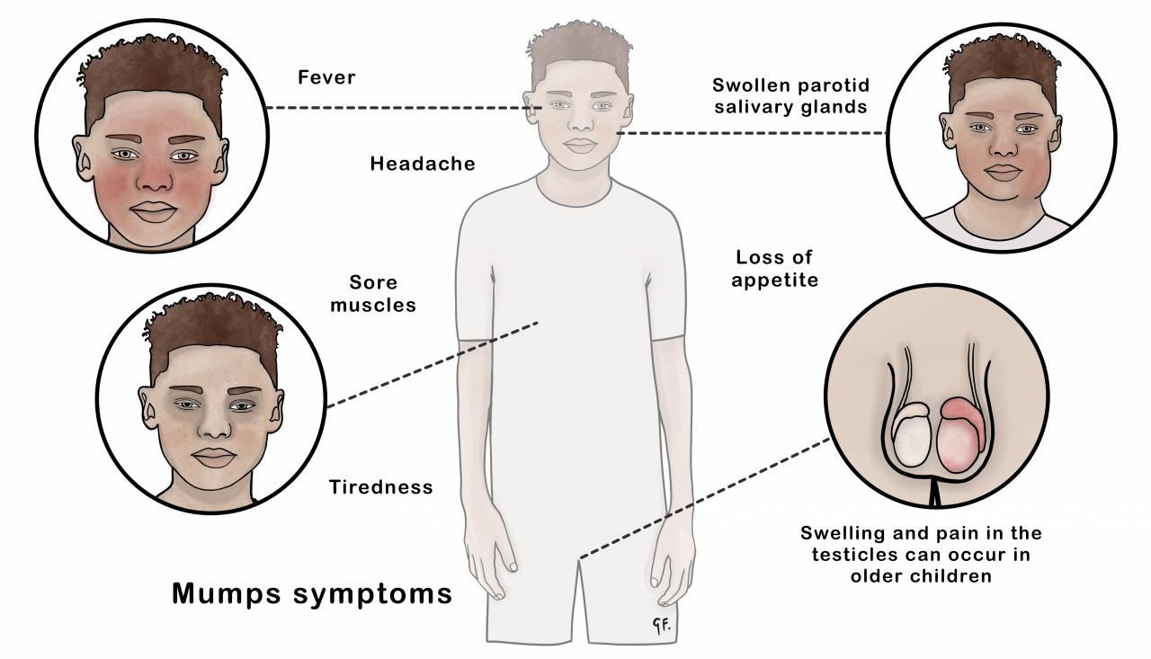 illustrations showing symptoms of mumps in young people