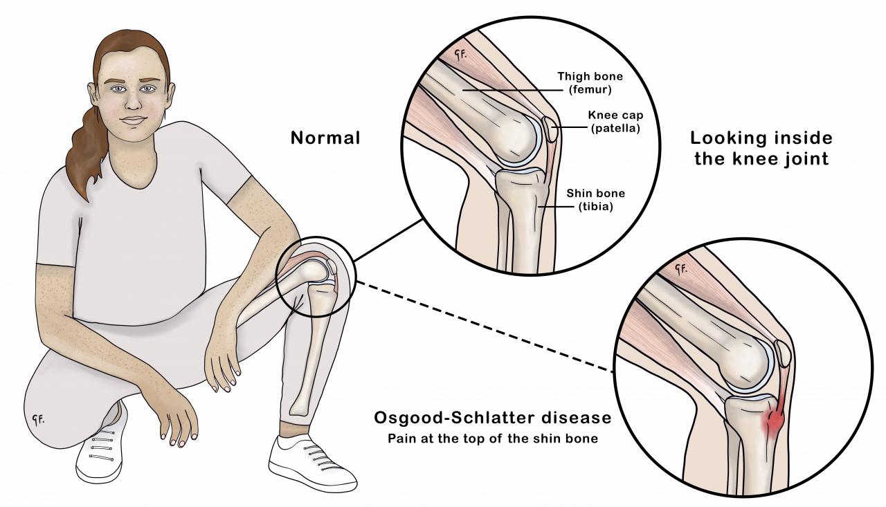Illustration of a teenage girl showing knee anatomy and osgood-schlatter disease