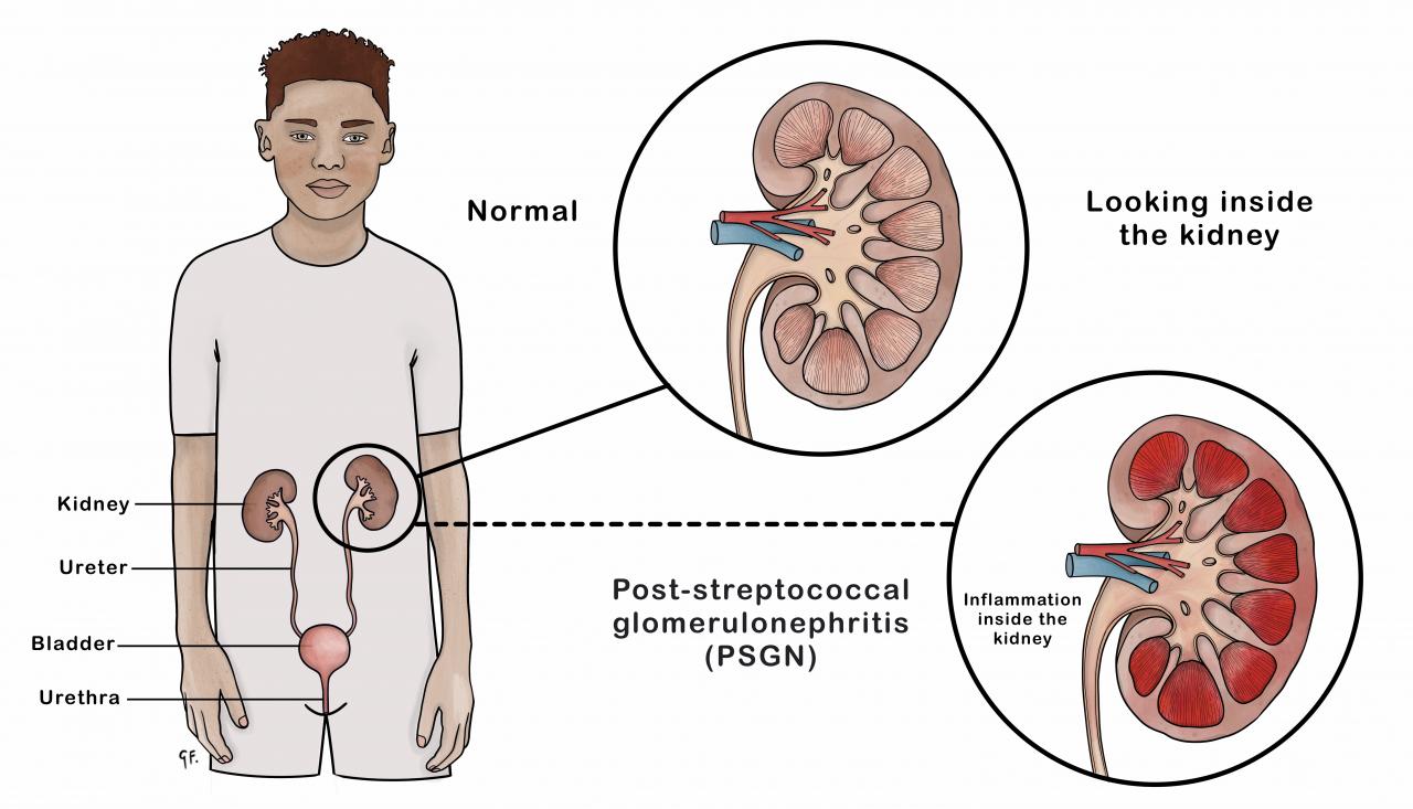 Illustration showing a normal kidney and a inflamed kidney from post streptococcal glomerulonephritis 