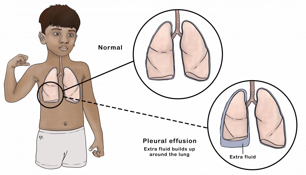 Illustration showing a child with insets highlighting normal lungs and pleural cavity compared with a pleural effusion.