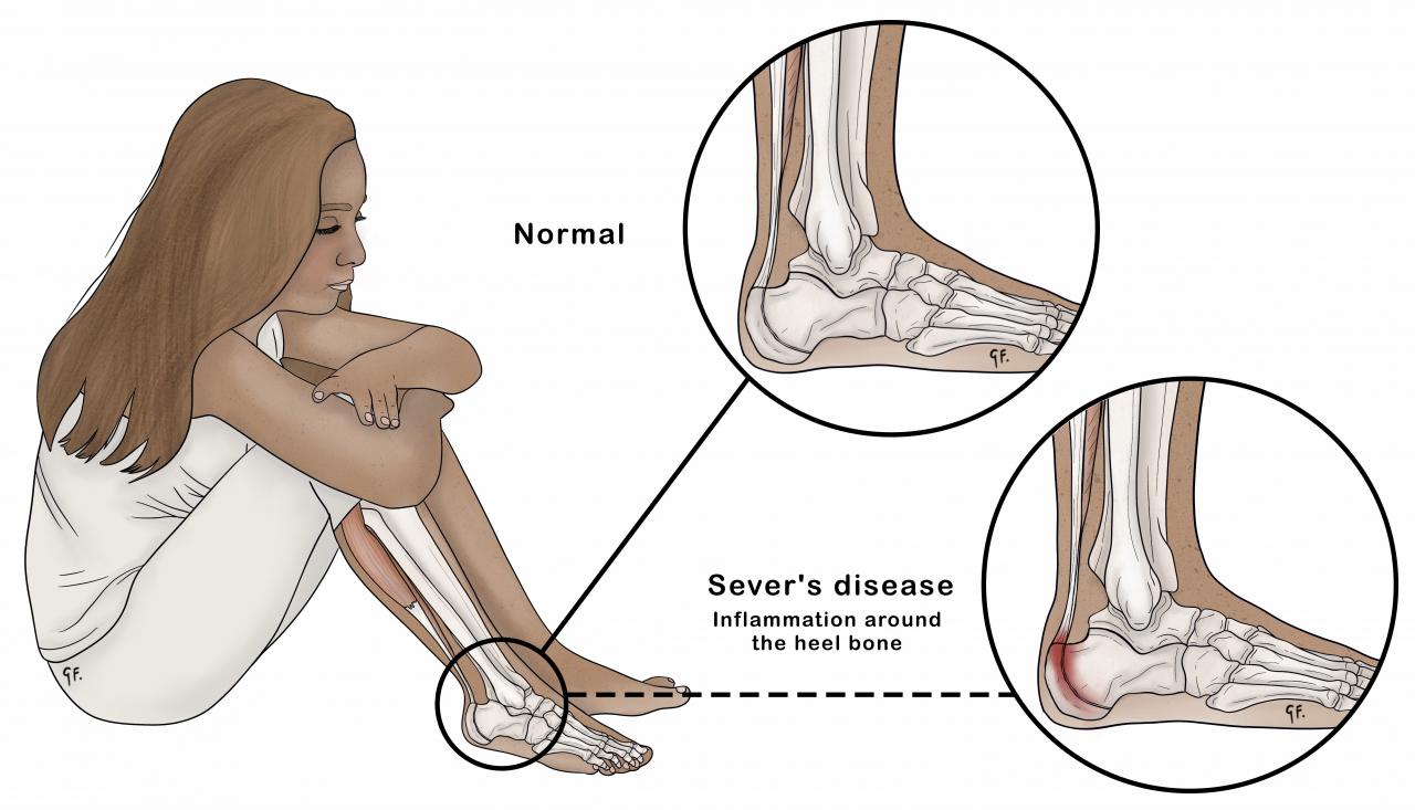 Illustration showing a child with lower leg anatomy then it compares a normal heel to a heel affected by Sever's disease 