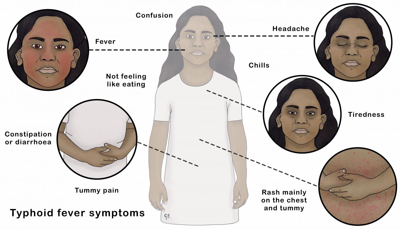 Illustration showing symptoms of typhoid fever in a child