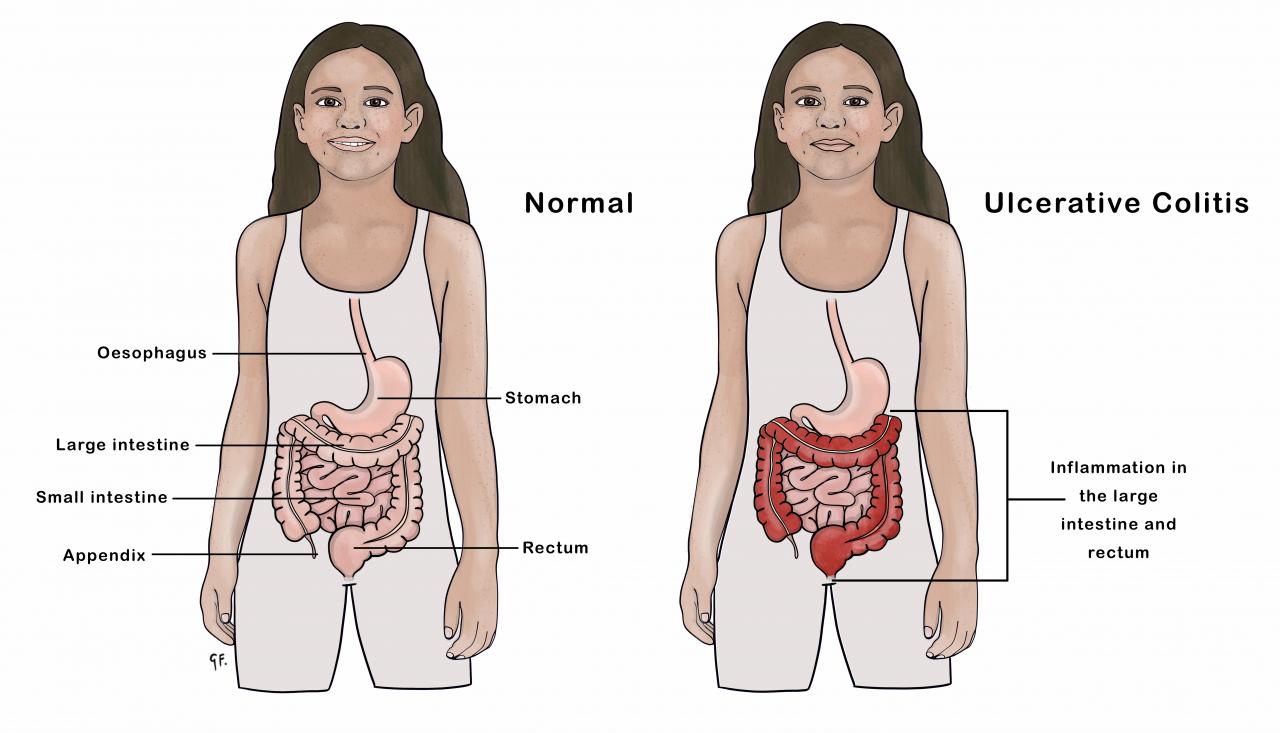 Illustrations showing young person with normal gastrointestinal tract and ulcerative colitis