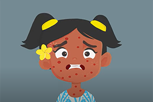 Illustration of child's face with measles rash