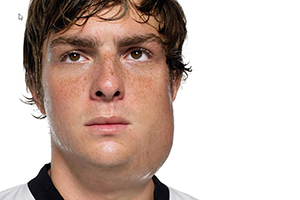 A boy with mumps who has swelling on his face